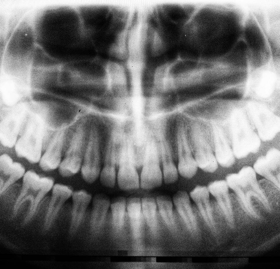 What Can I Do to Stop Grinding My Teeth?