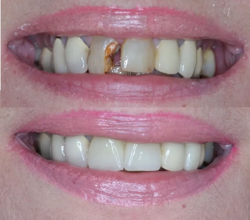 Dental crowns at Reimche-Vu Family Dentistry