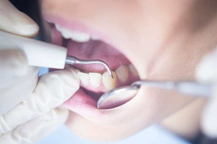 Dental fillings at Reimche-Vu Family Dentistry