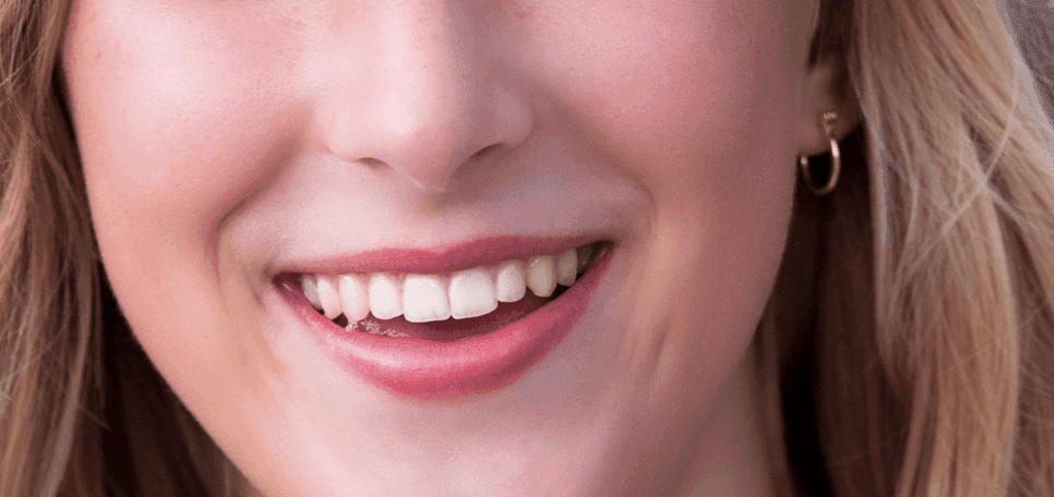 Teeth whitening result