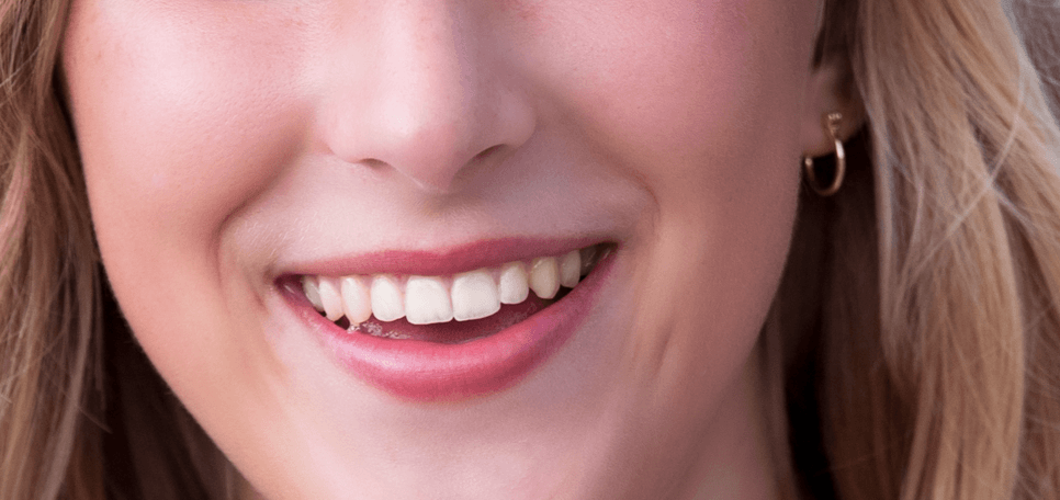 Professional teeth whitening at Goldendale Dental Care